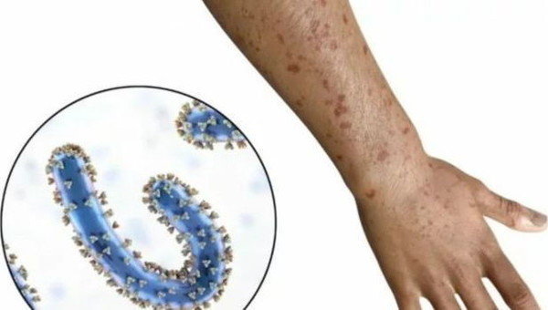 Govt Issues Advisory to Kenyans After Marbug Virus Outbreak in Tanzania