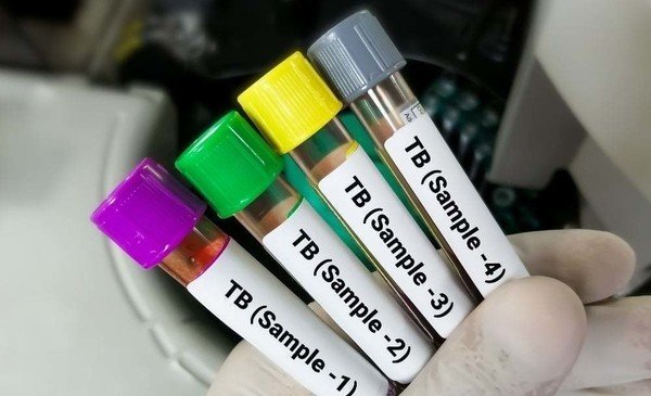 Casual encounter: New research challenges thinking on the places where TB is transmitted